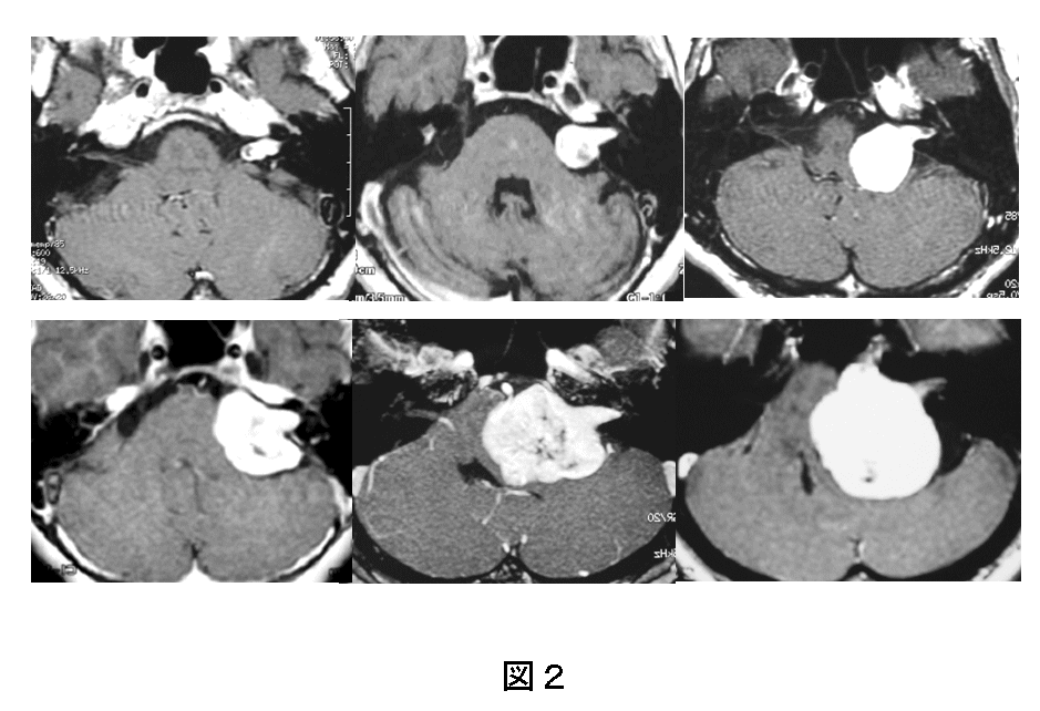 聴神経腫瘍・小脳橋角部腫瘍の説明