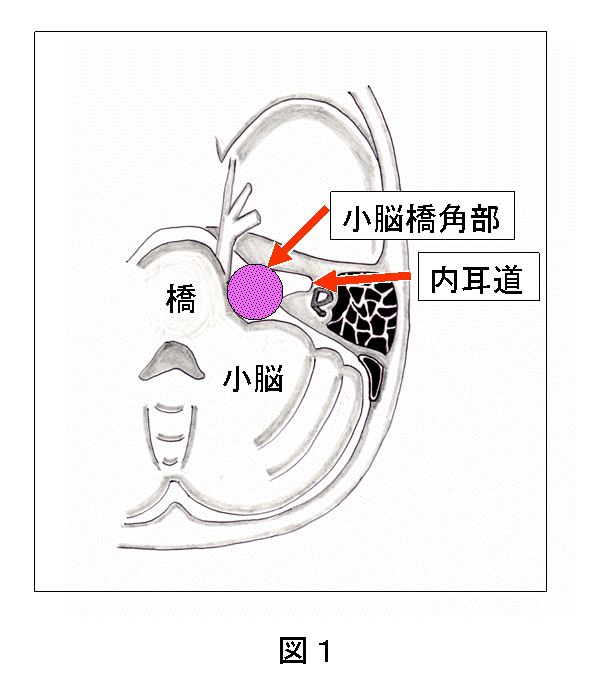 聴神経腫瘍 小脳橋角部腫瘍の説明