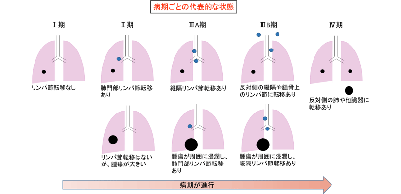 病期ごとの代表的な状態 Ⅰ期:リンパ節に転移なし Ⅱ期:肺門部リンパ節転移あり。リンパ節に転移はないが、腫瘍が大きい ⅢA期:縦隔リンパ節転移あり。腫瘍が周囲に浸潤し、肺門部リンパ節転移あり。 ⅢB期:反対側の縦隔や鎖骨上のリンパ節に転移あり。腫瘍が周囲に浸潤し、縦隔リンパ節転移あり Ⅳ期:反対側の肺や他臓器に転移あり