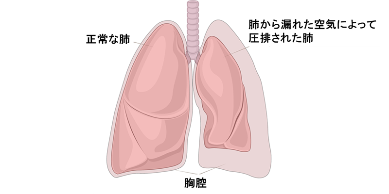 肺から漏れた空気によって圧排された肺と健常な肺