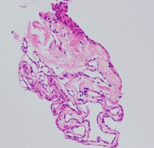 endodermalcyst