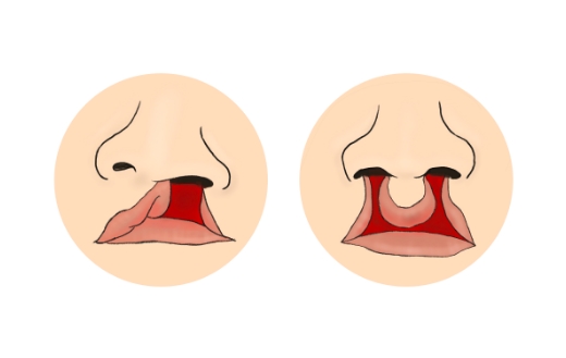 口唇口蓋裂のイラスト