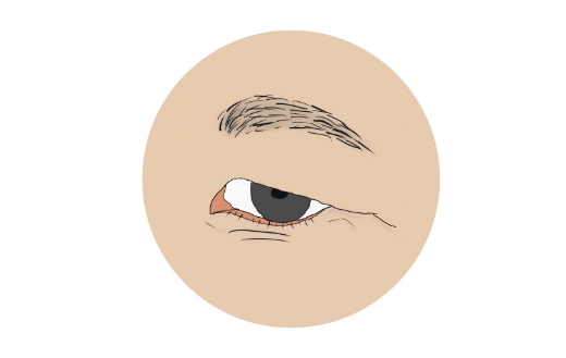 眼瞼下垂のイラスト