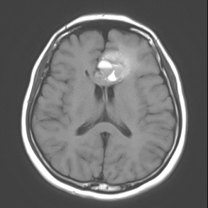 大脳海綿状血管腫のMRI画像です。左前頭葉に病変を認めます。