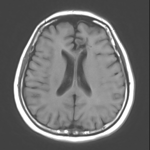 大脳海綿状血管腫に対する内視鏡治療後の画像です。