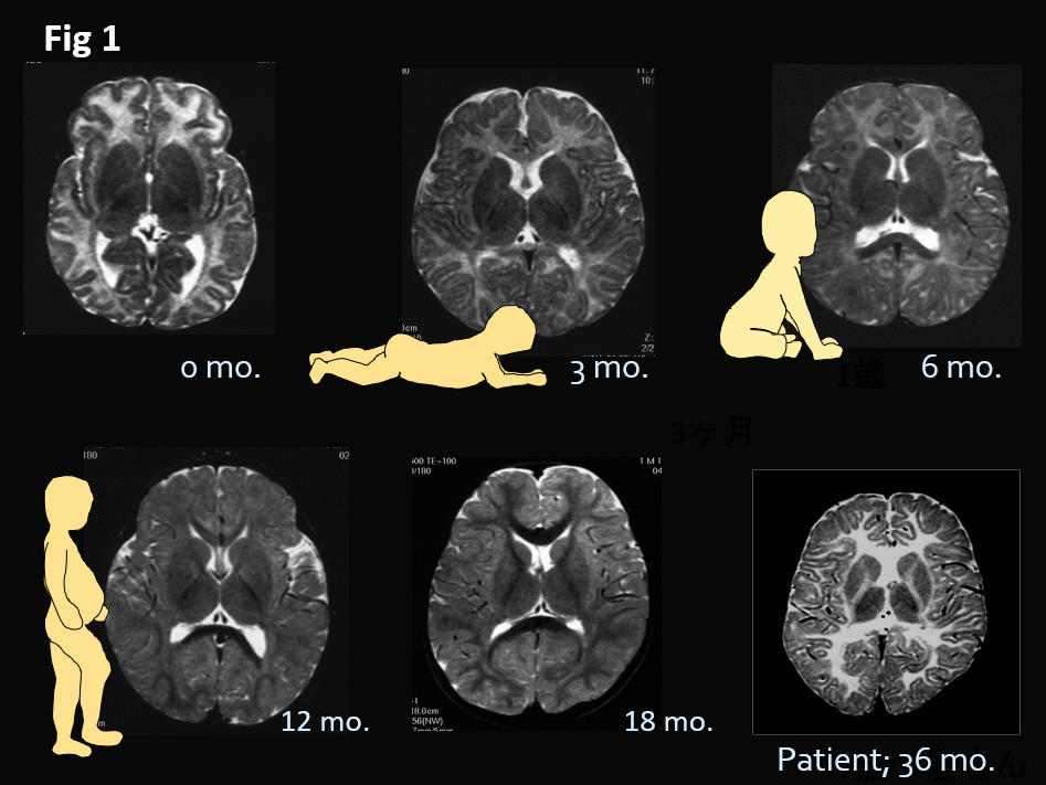 Figure 1. T2-weighted magnetic resonance imaging (MRI)