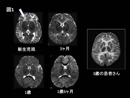 図１，MRI（核磁気共鳴画像）、T2強調像