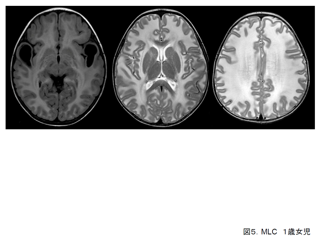 図5. MLC．１歳女児．FLAIR（左）とT2強調画像．白質量が増加し高信号、側頭葉先端部に嚢胞形成．