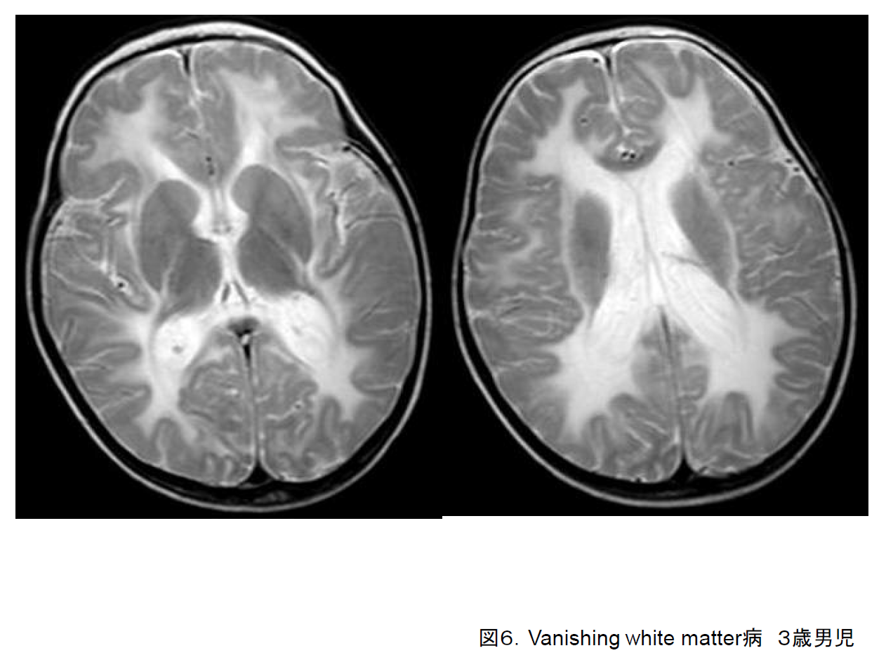 図6. Vanishing white matter病．３歳男児．T2強調画像．脳梁と内包前脚および一部の皮質下白質以外の白質は高信号．