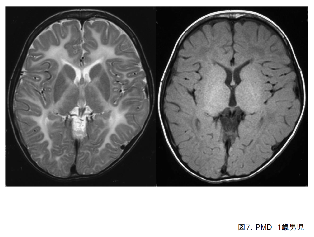 図7. Pelizaeus-Merzbacher病．１歳男児．T2強調画像とT1強調画像．先天型PMD．T2では髄鞘化はまったくみられない。T1では内包に高信号を認める．