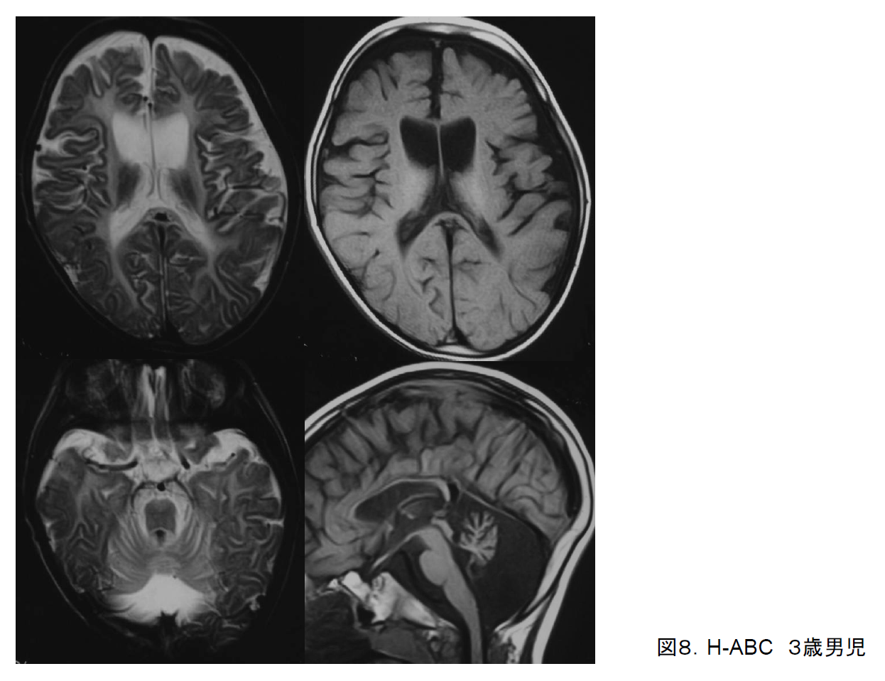図8. H-ABC．４歳男児．T2強調画像（左）とT1強調画像．両側尾状核頭と被殻の萎縮と信号異常が大きな特徴．T1では髄鞘は皮質と等信号．小脳萎縮と脳梁低形成も認める． 