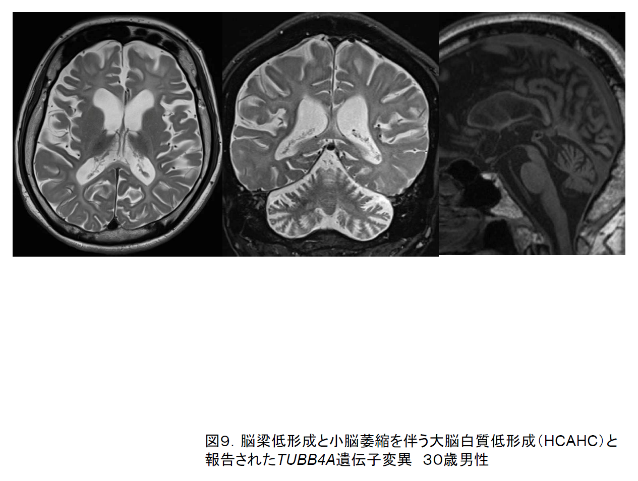 図9. TUBB4A遺伝子変異．３０歳男性．脳梁低形成と小脳萎縮を伴う大脳白質低形成（HCAHC）を認め尾状核頭や被殻はやや小振りなものの保たれている．