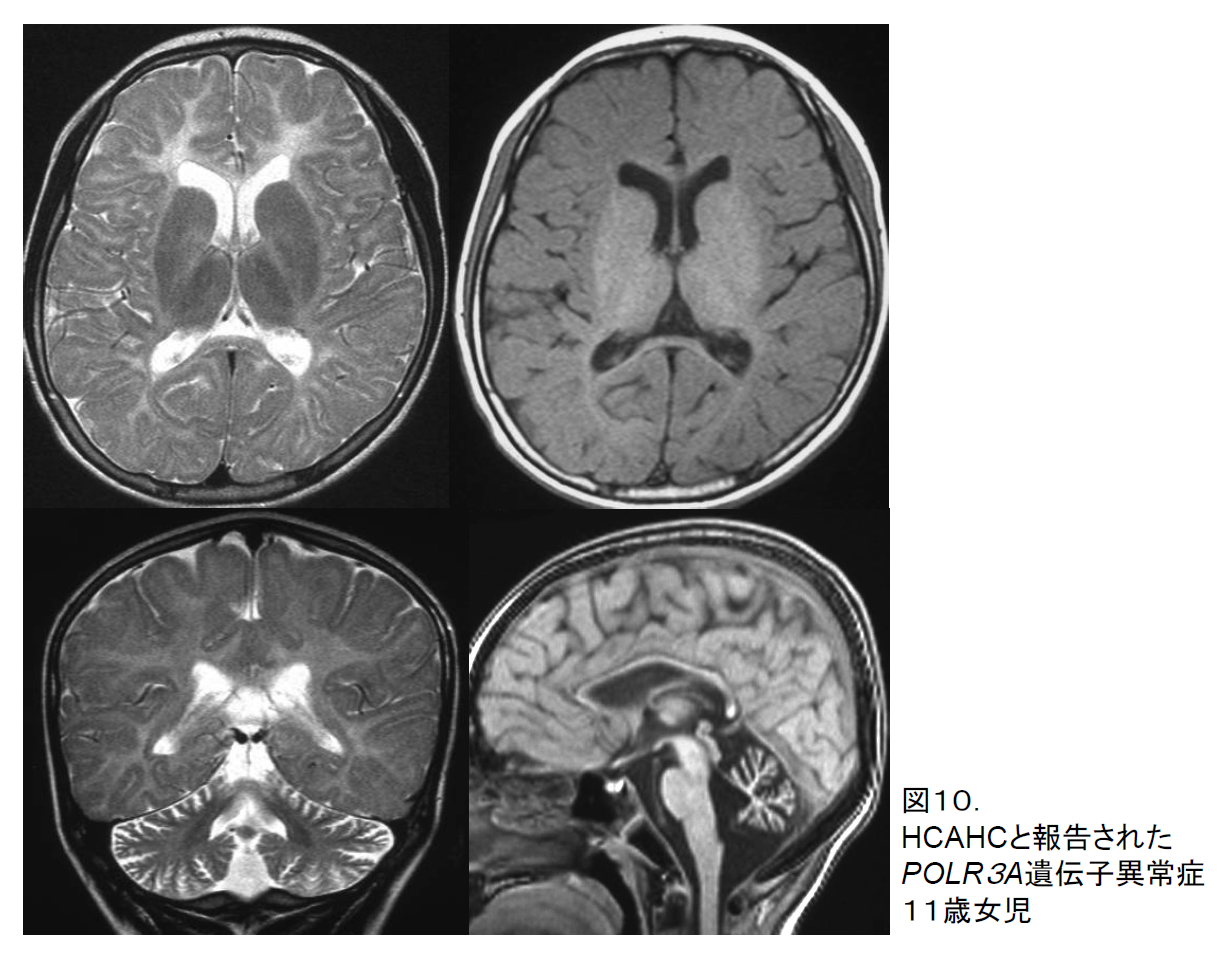 図10. Pol III関連白質変性症．１１歳女児．T2強調画像（左）とT1強調画像．髄鞘化はT2では見られない、T1では脳梁に辛うじて認める．HCAHCとして報告した例．のちにPOL3Aの異常が見出された．