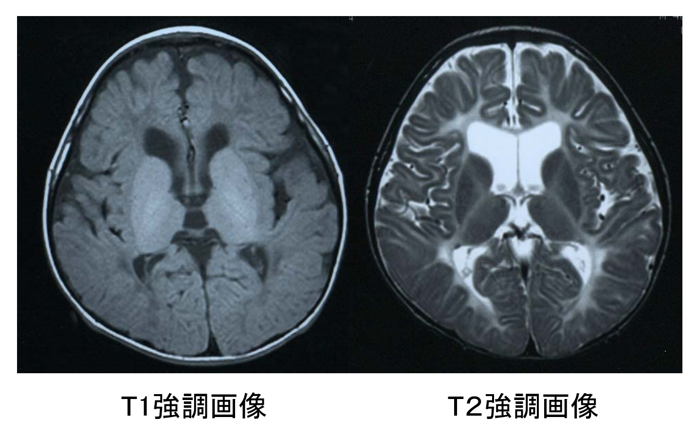 図2　Pelizaeus-Merzbacher 病（先天型、PLP遺伝子点変異 Pro 210 Leu）10歳代男性。生直後より水平性眼振、頭部の振戦、吸気性喘鳴を認めた。頚定なく、言語も未獲得である。内包後脚を含めて広範なT1低信号、T2高信号を認める。
