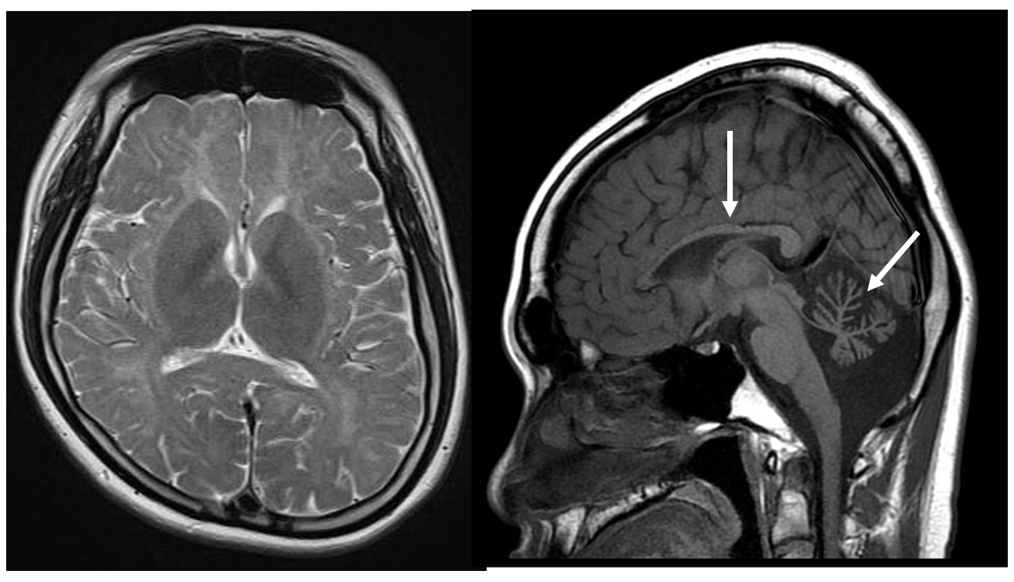 図4　4H syndrome (HLD8) ないしDiffuse cerebral hypomyelination with cerebellar atrophy and hypoplasia of the corpus callosum (HCAHC)