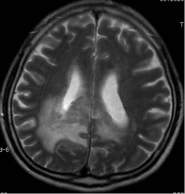 Figure 1；Malignant lymphoma (T2 weighted image )