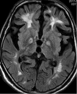 図5；CO中毒（FLAIR像２）