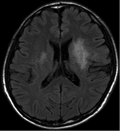 Figure 9. SLE（FLAIR image）