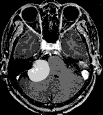 造影MRI