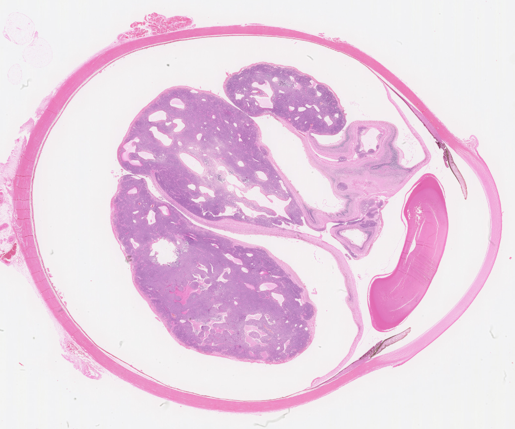 retionoblastoma