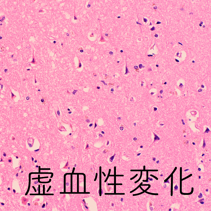 Ischemic cell change