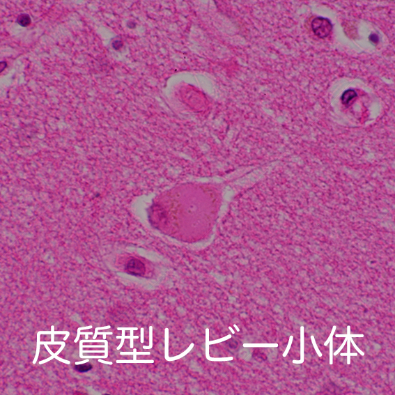 cortical-type Lewy bodies