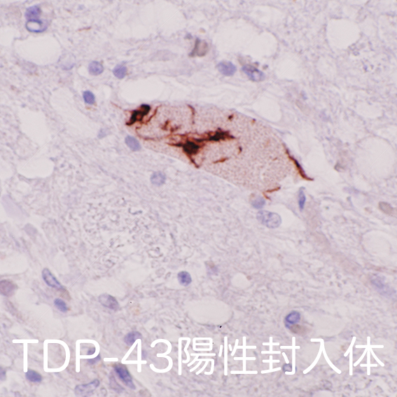 TDP-43 inclusions