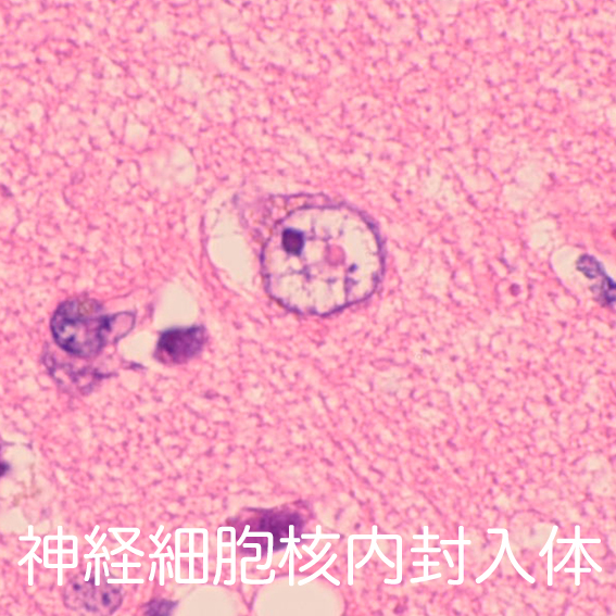 Neuronal intranuclear inclusion bodies