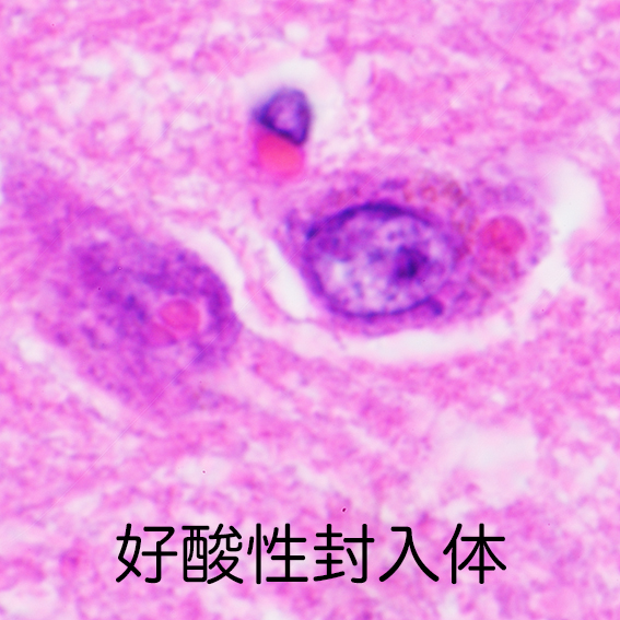 Neuronal eosinophilic inclusions