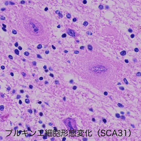 Purkinge cell in SCA31