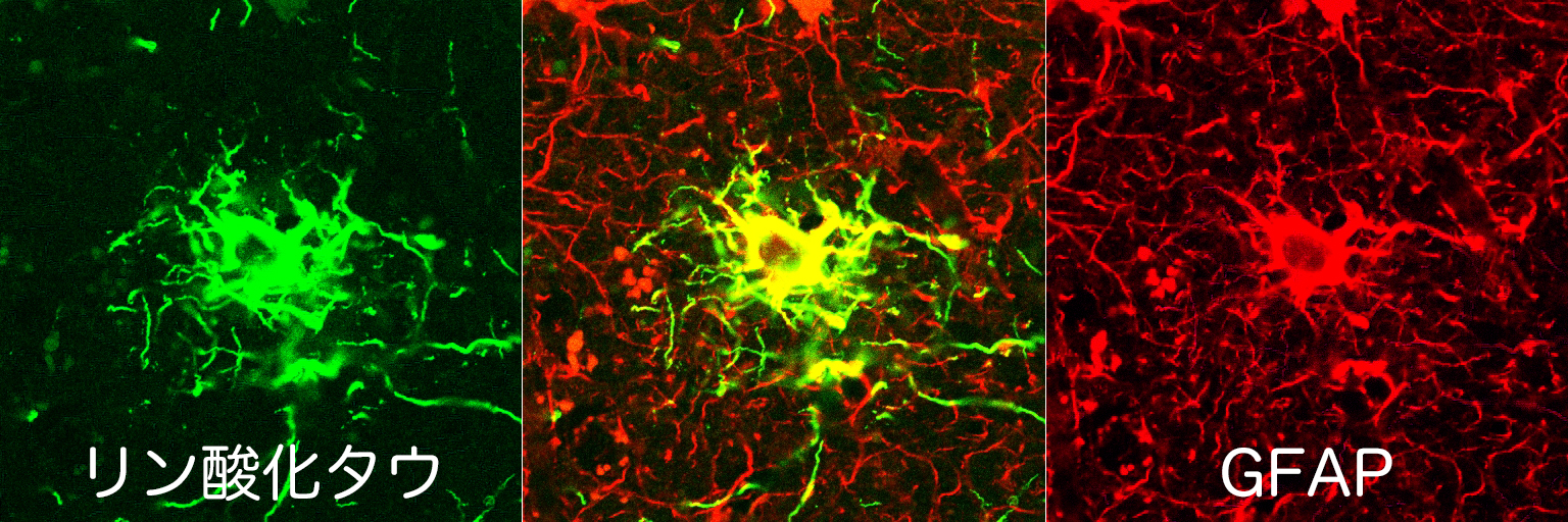 astrocytic plaque