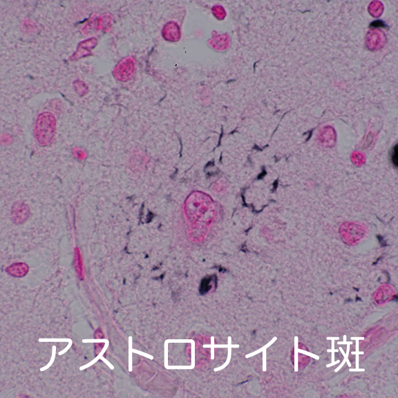 astrocytic plaques