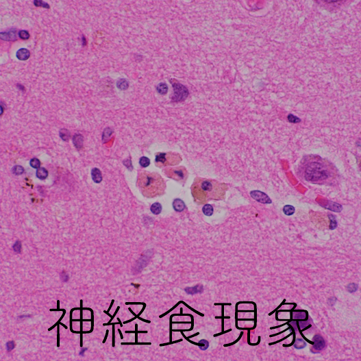 neuronophagia