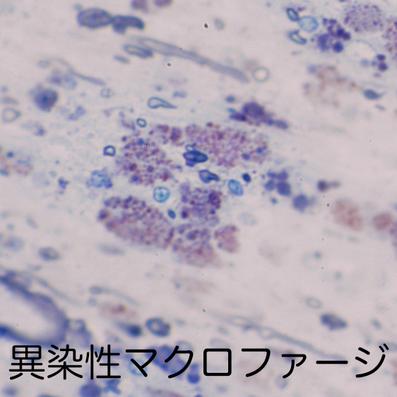 metachromatic macrophages in MLD