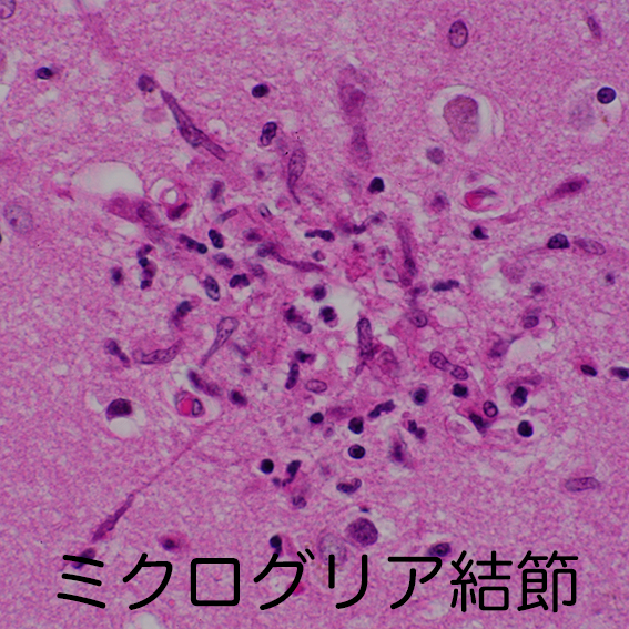 microglial nodule