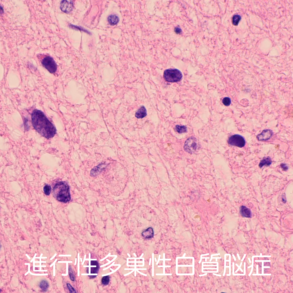 progressive multifocal leukoencephalopathy