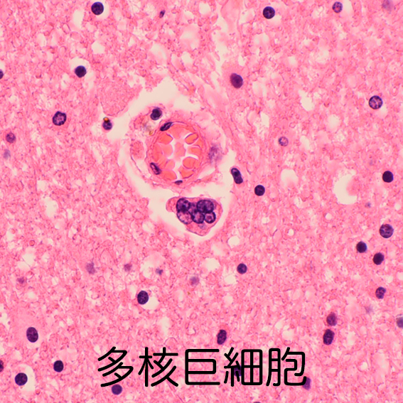 multinucleated giant cells in HIV