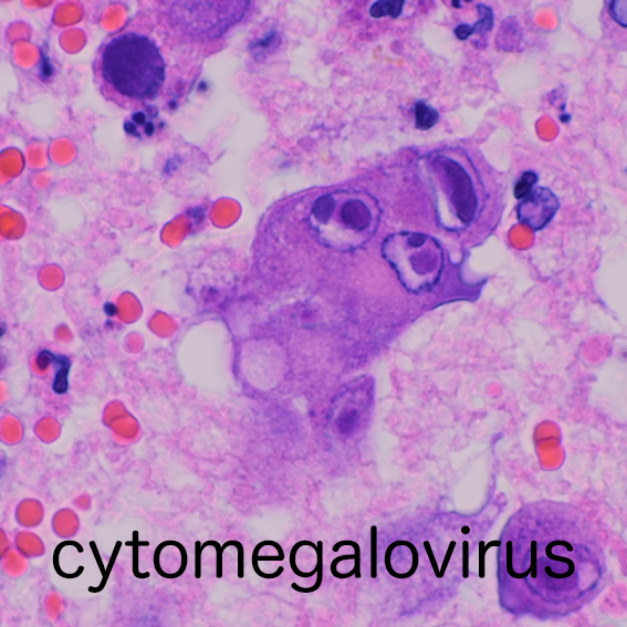 cytomegalovirus