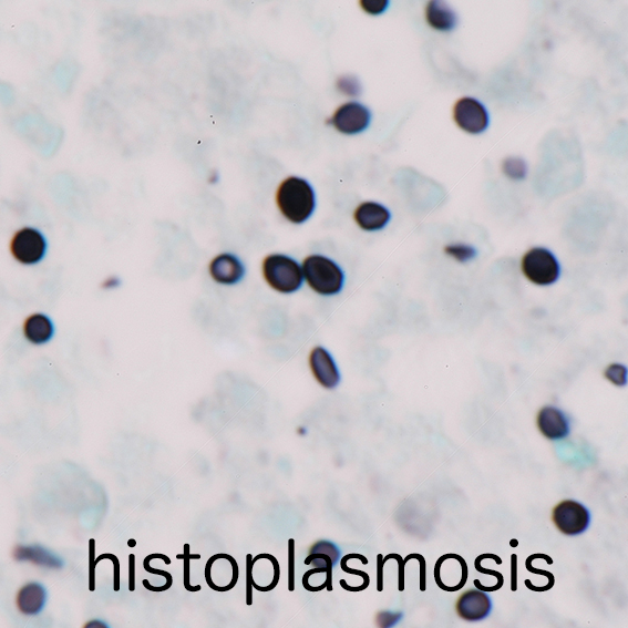 histoplasmosis