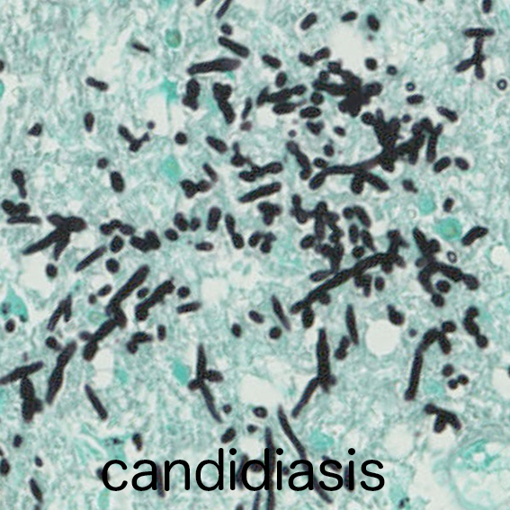 candidiasis