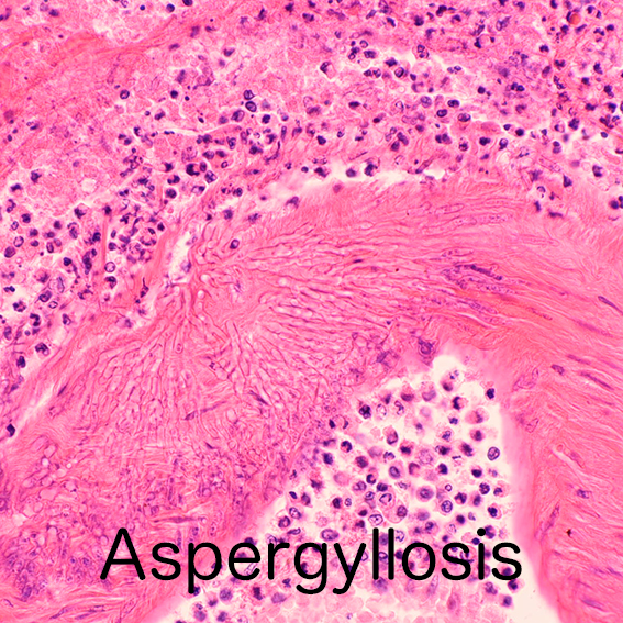 aspergillosis