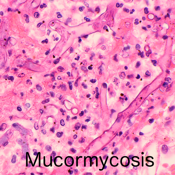 mucormycosis