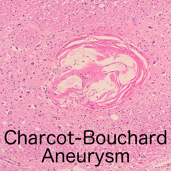 Charcot-Bouchard aneurysm