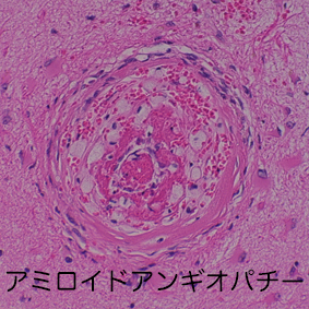 amyloid angiopathy