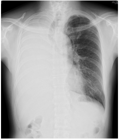右全無気肺のレントゲン写真
