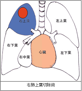 肺葉切除（1葉、2葉）