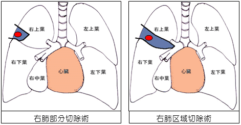 肺区域切除、肺部分切除