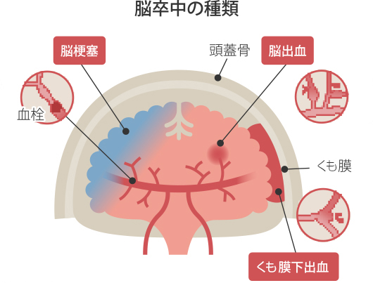 脳卒中後の認知症の兆候