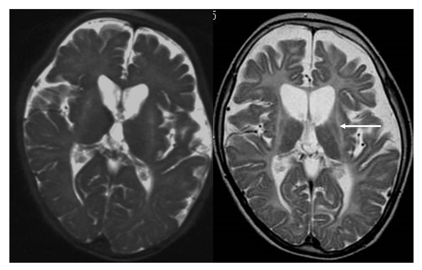 図3　Hypomeylination with atrophy of the basal ganglia and cerebellum (H-ABC). （名古屋市立大学小児科　藤本伸治先生、服部文子先生のご好意による）