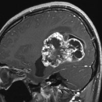 anaplasticependyma12